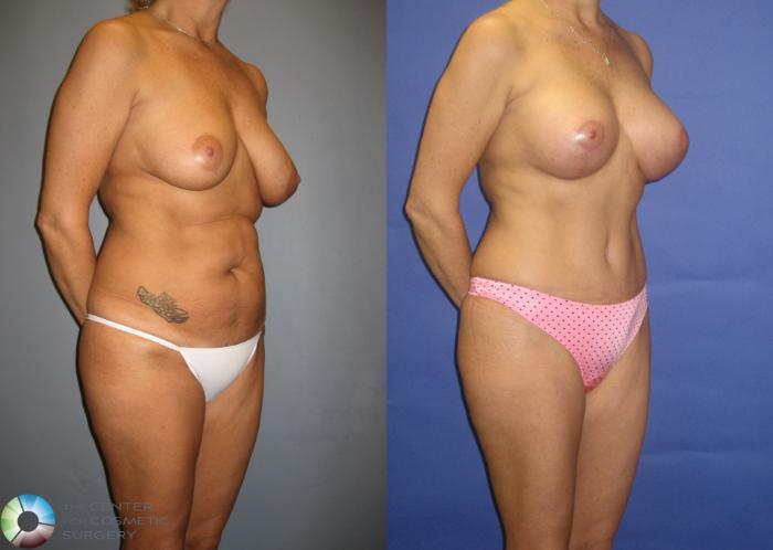 Before & After Tummy Tuck Case 305 View #4 View in Golden, CO