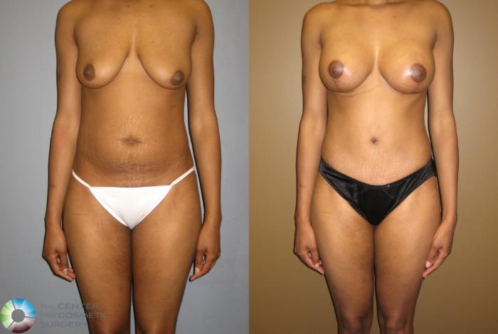 Before & After Tummy Tuck Case 310 View #1 View in Golden, CO