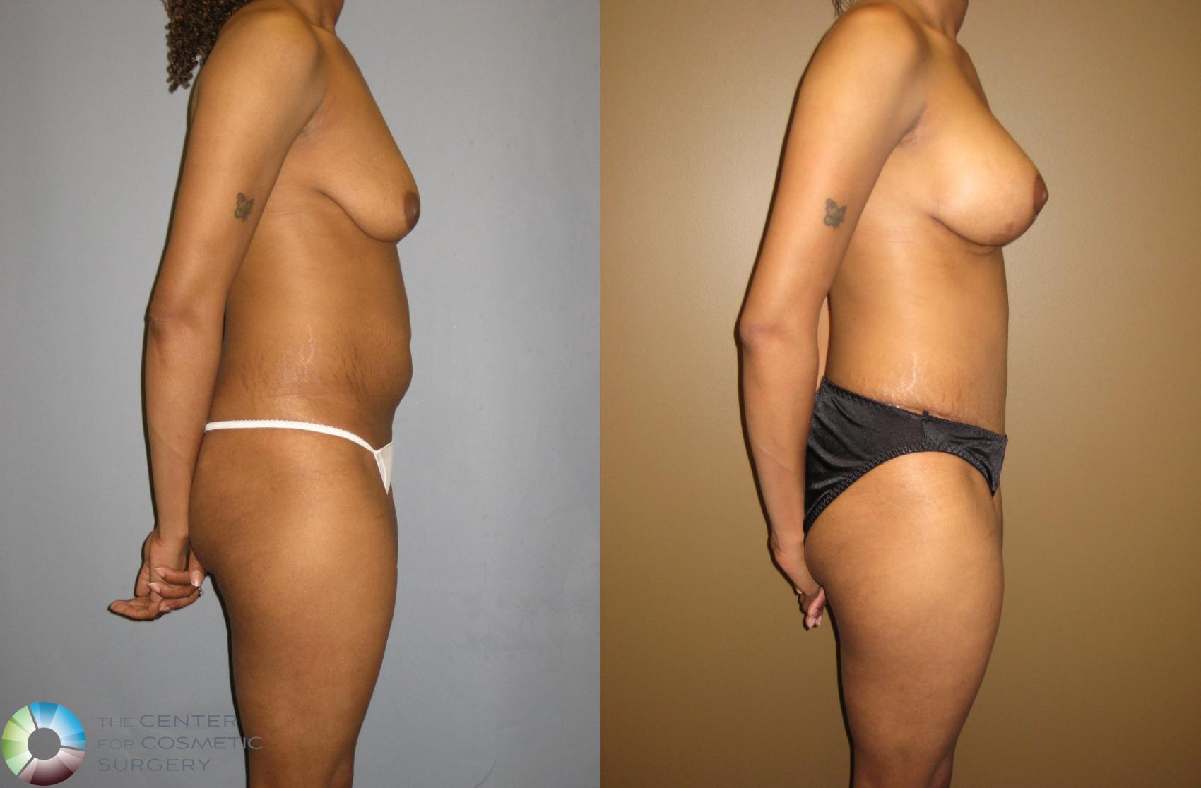 Before & After Tummy Tuck Case 310 View #2 View in Golden, CO