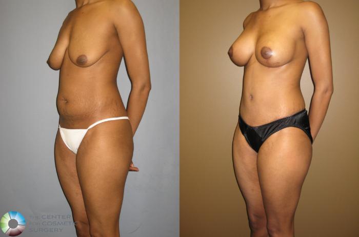 Before & After Tummy Tuck Case 310 View #3 View in Golden, CO
