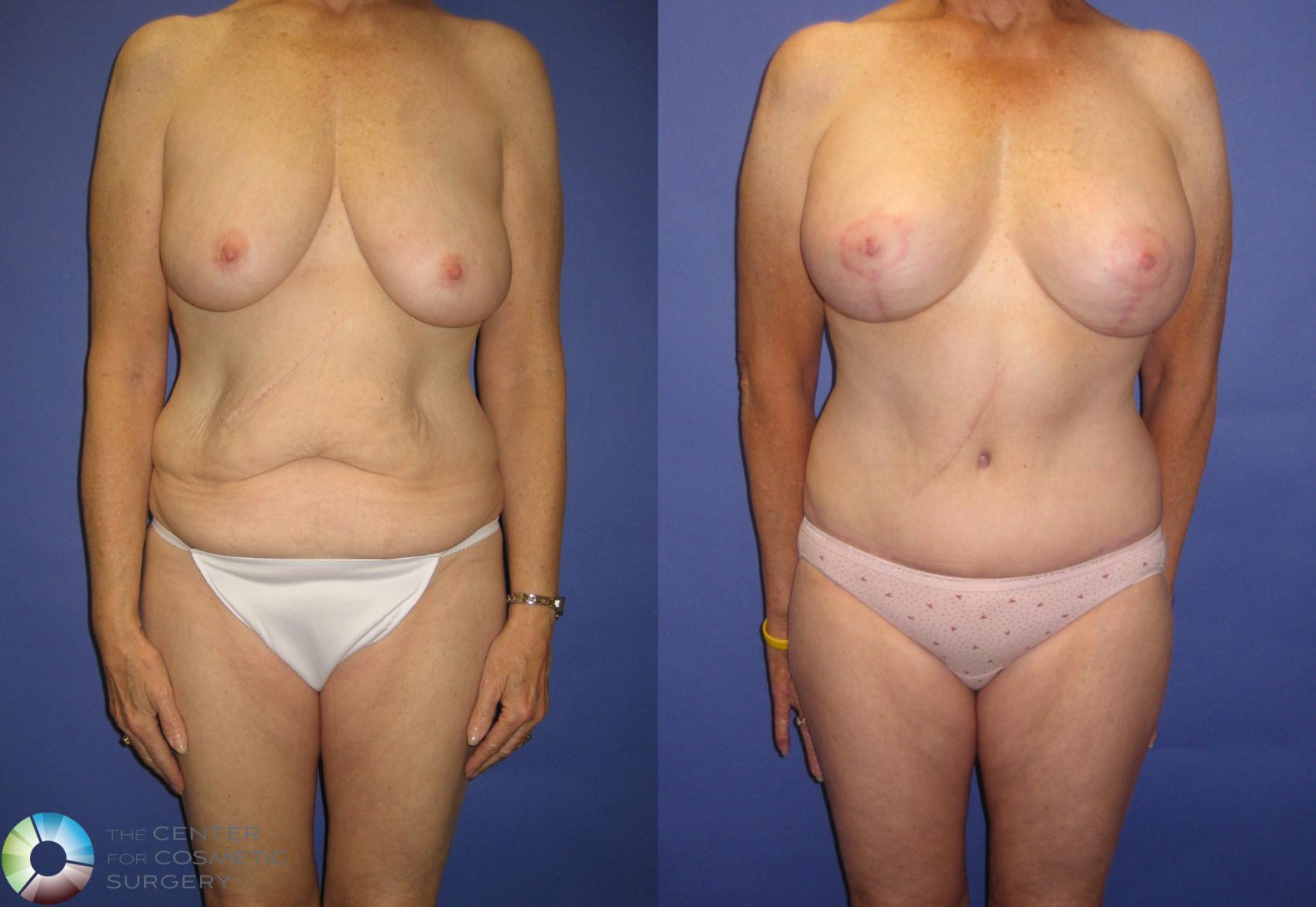 Before & After Breast Augmentation Case 317 View #1 in Denver and Colorado Springs, CO