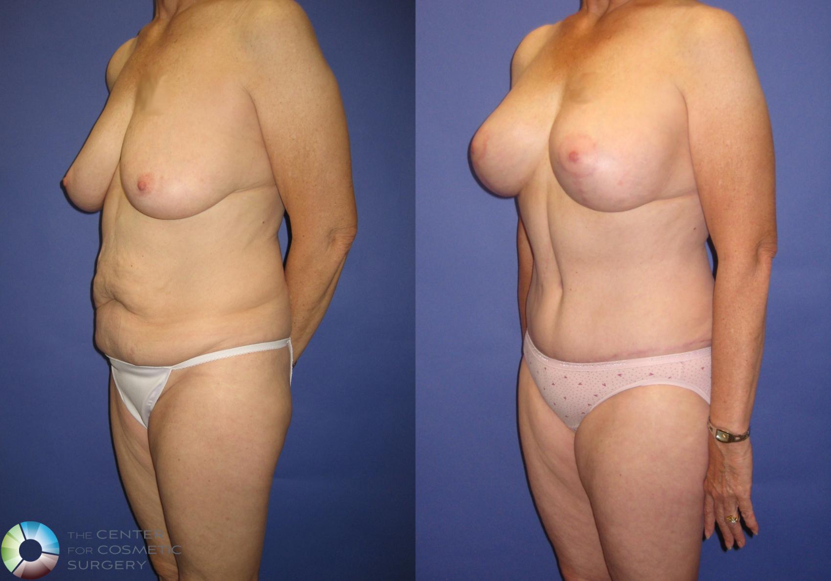 Before & After Tummy Tuck Case 317 View #2 in Denver and Colorado Springs, CO