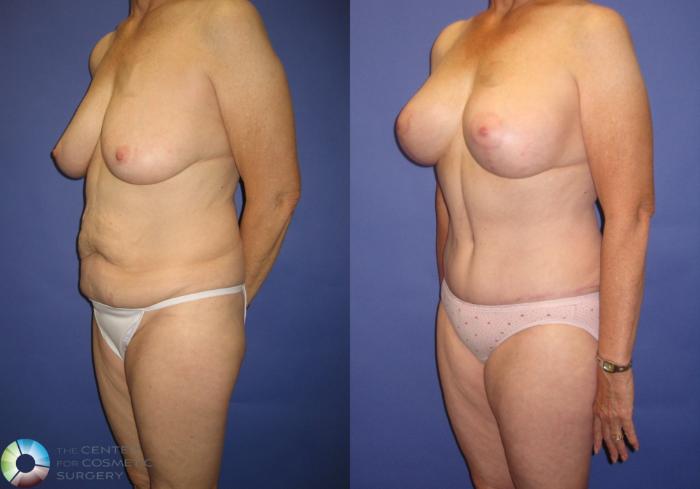 Before & After Breast Augmentation Case 317 View #2 View in Golden, CO