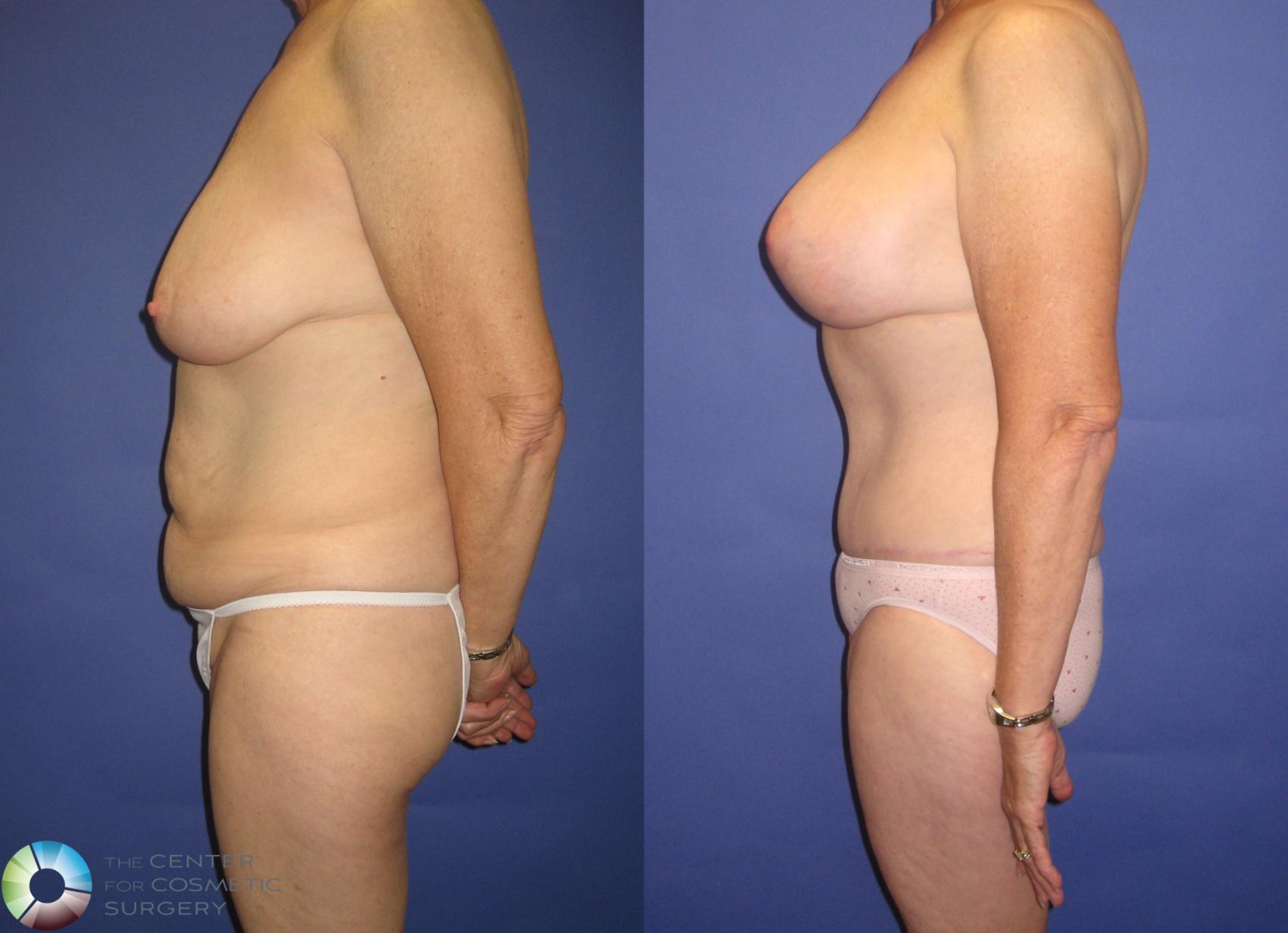 Before & After Tummy Tuck Case 317 View #3 in Denver and Colorado Springs, CO