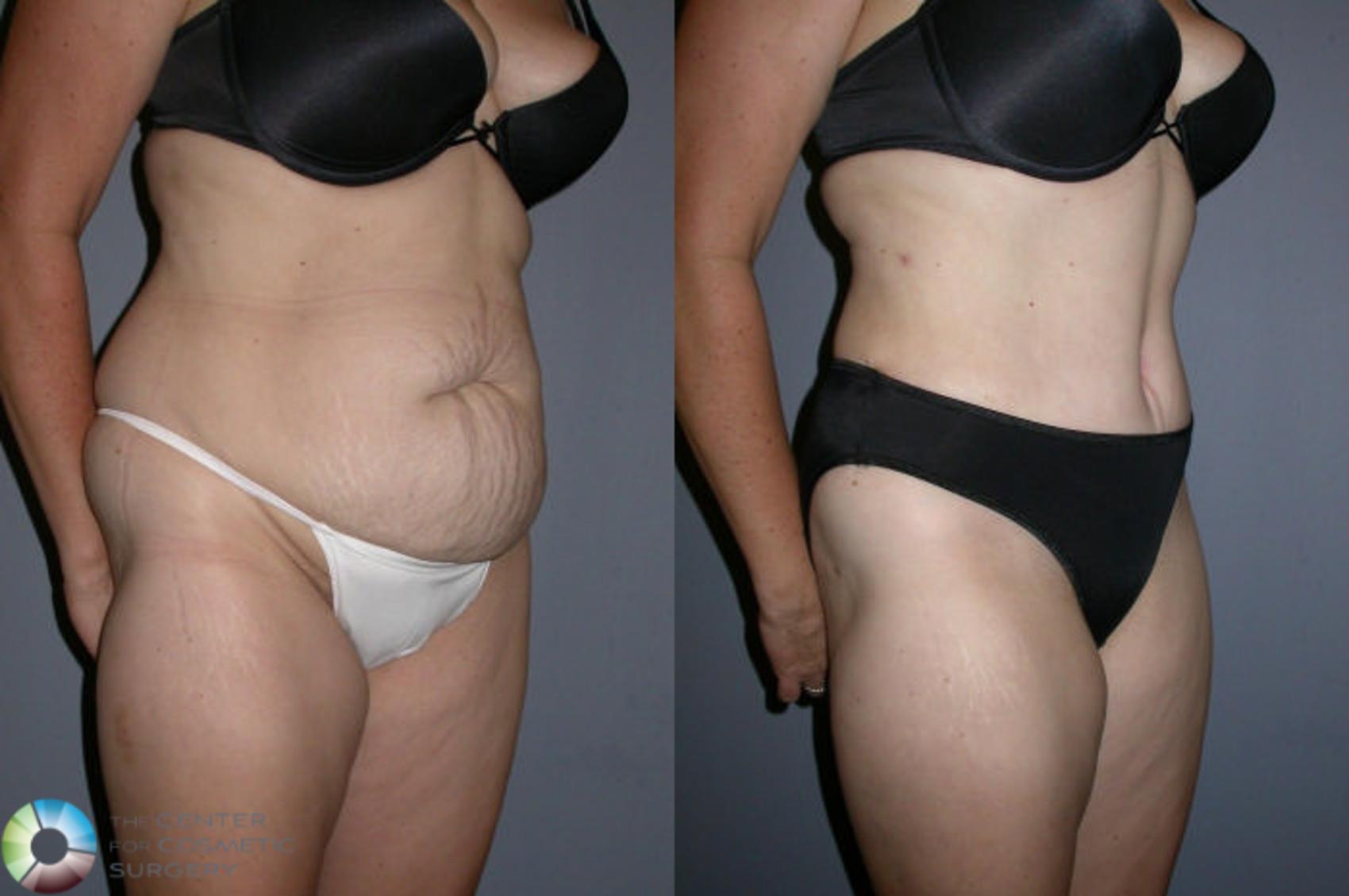 Before & After Tummy Tuck Case 32 View #1 in Denver and Colorado Springs, CO