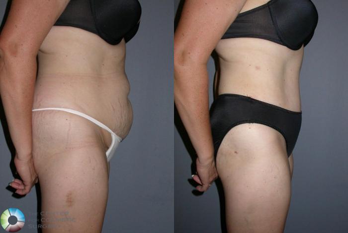 Before & After Tummy Tuck Case 32 View #2 View in Golden, CO