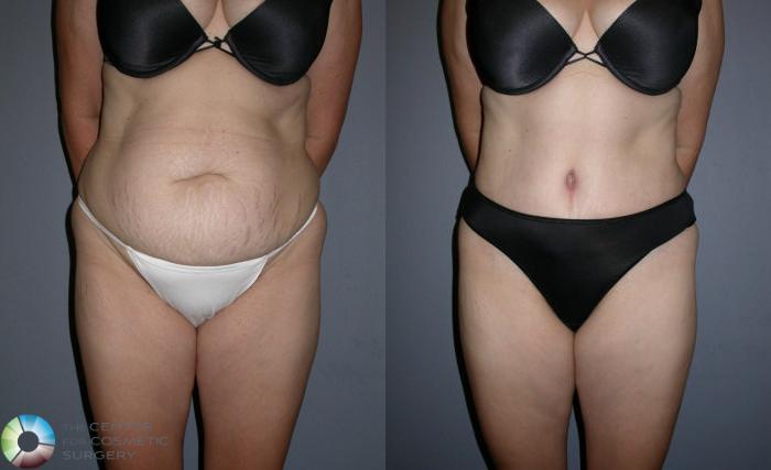 Before & After Tummy Tuck Case 32 View #3 View in Golden, CO