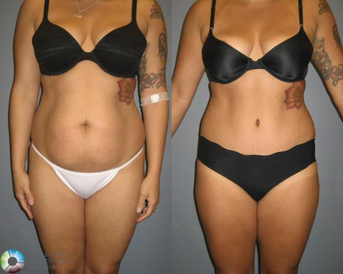 Before & After Tummy Tuck Case 321 View #1 in Denver and Colorado Springs, CO
