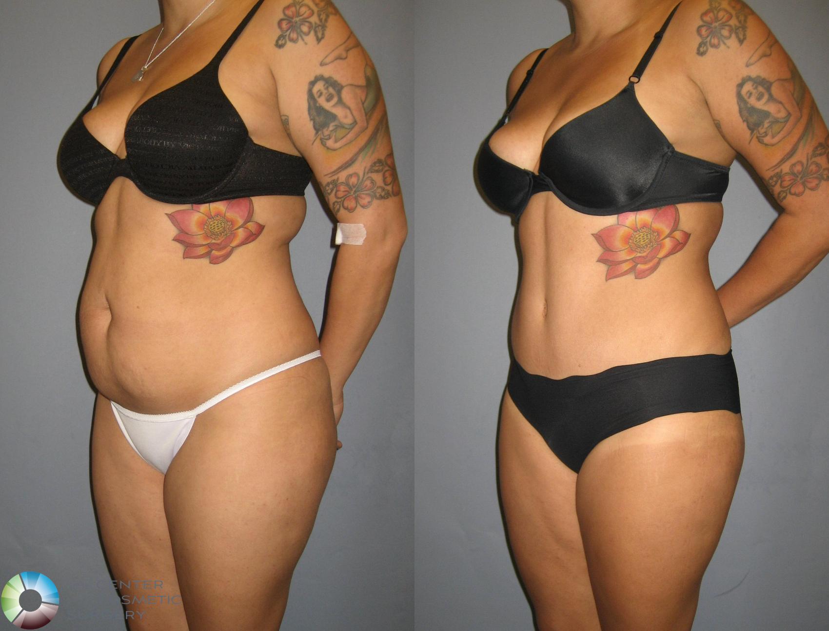 Before & After Tummy Tuck Case 321 View #2 in Denver and Colorado Springs, CO