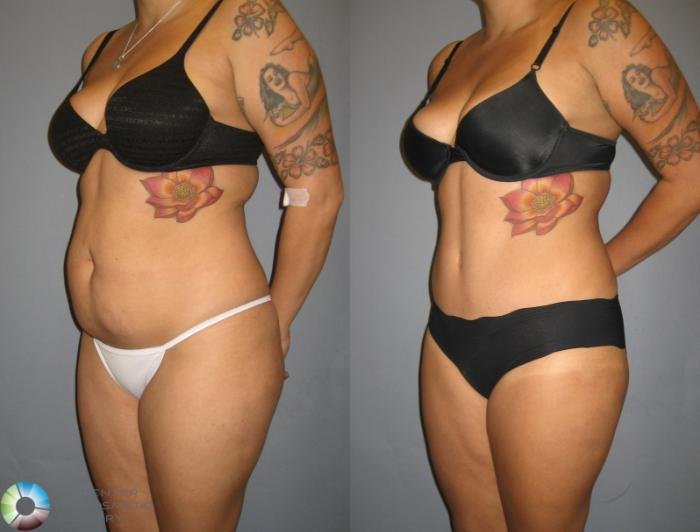 Before & After Tummy Tuck Case 321 View #2 in Denver and Colorado Springs, CO