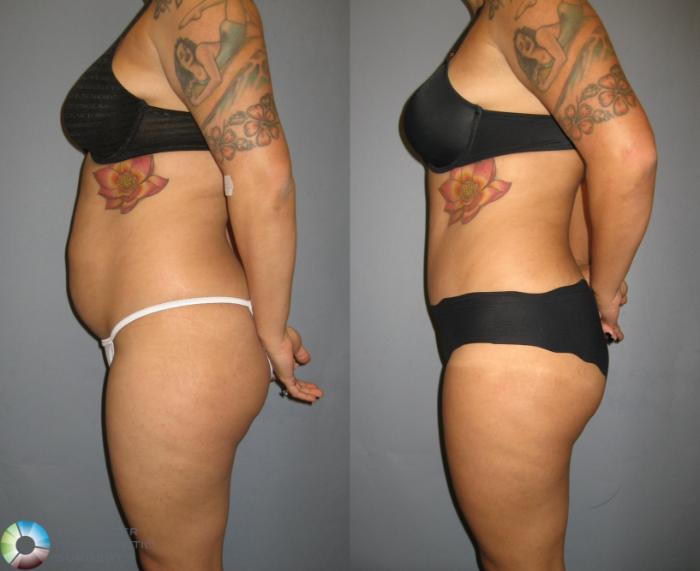 Before & After Tummy Tuck Case 321 View #3 in Denver and Colorado Springs, CO