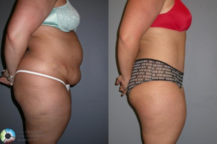 Before & After Tummy Tuck Case 323 View #1 View in Golden, CO