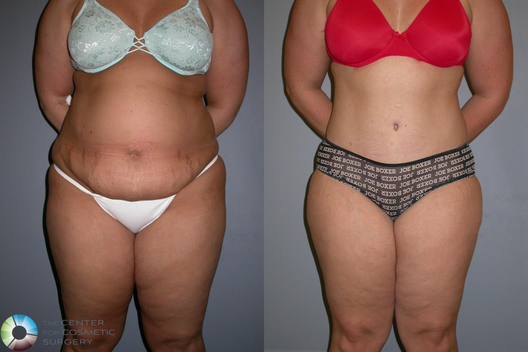 Before & After Tummy Tuck Case 323 View #2 in Denver and Colorado Springs, CO