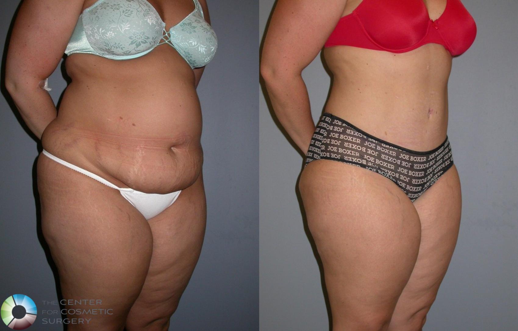 Before & After Tummy Tuck Case 323 View #3 in Denver and Colorado Springs, CO