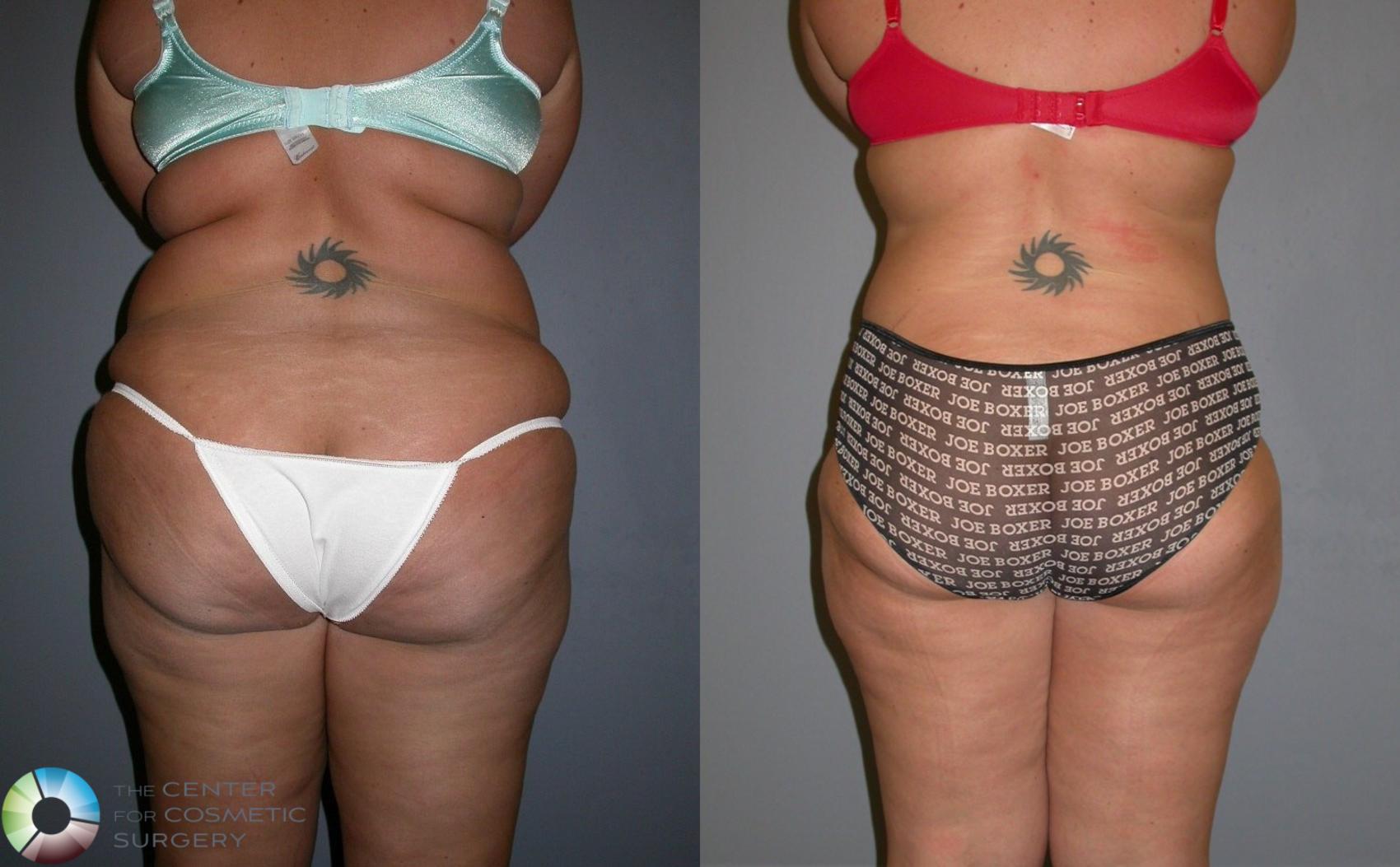 Before & After Tummy Tuck Case 323 View #4 in Denver and Colorado Springs, CO