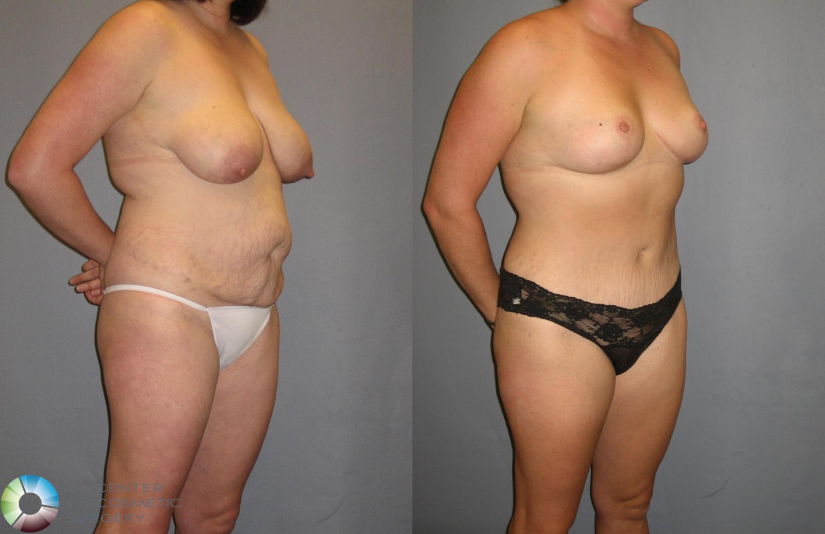 Before & After Breast Reduction Case 324 View #2 in Denver and Colorado Springs, CO