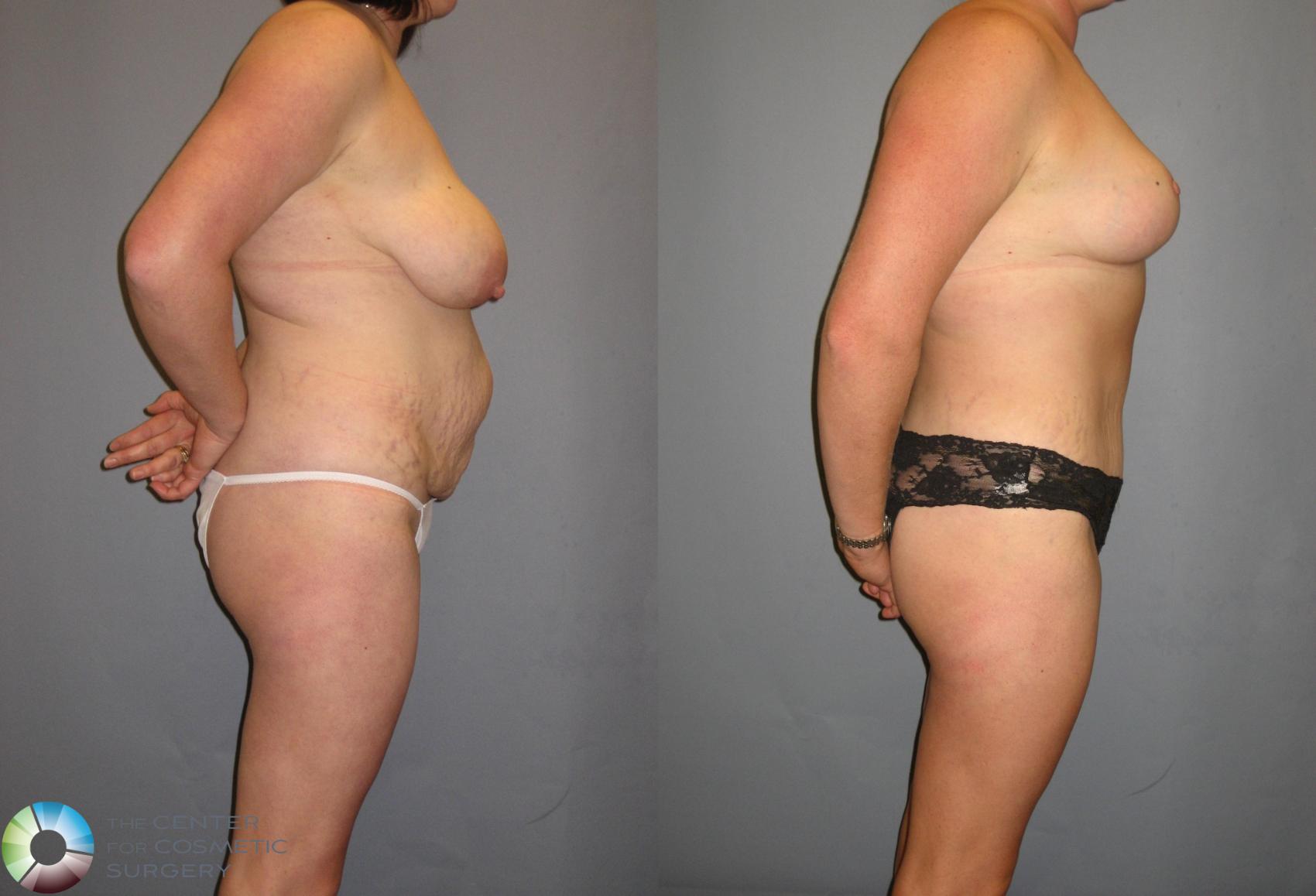 Before & After Tummy Tuck Case 324 View #3 View in Golden, CO