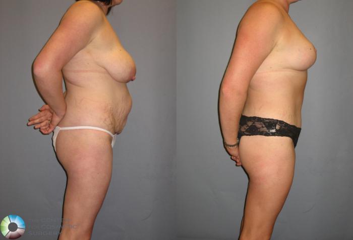 Before & After Breast Reduction Case 324 View #3 View in Golden, CO
