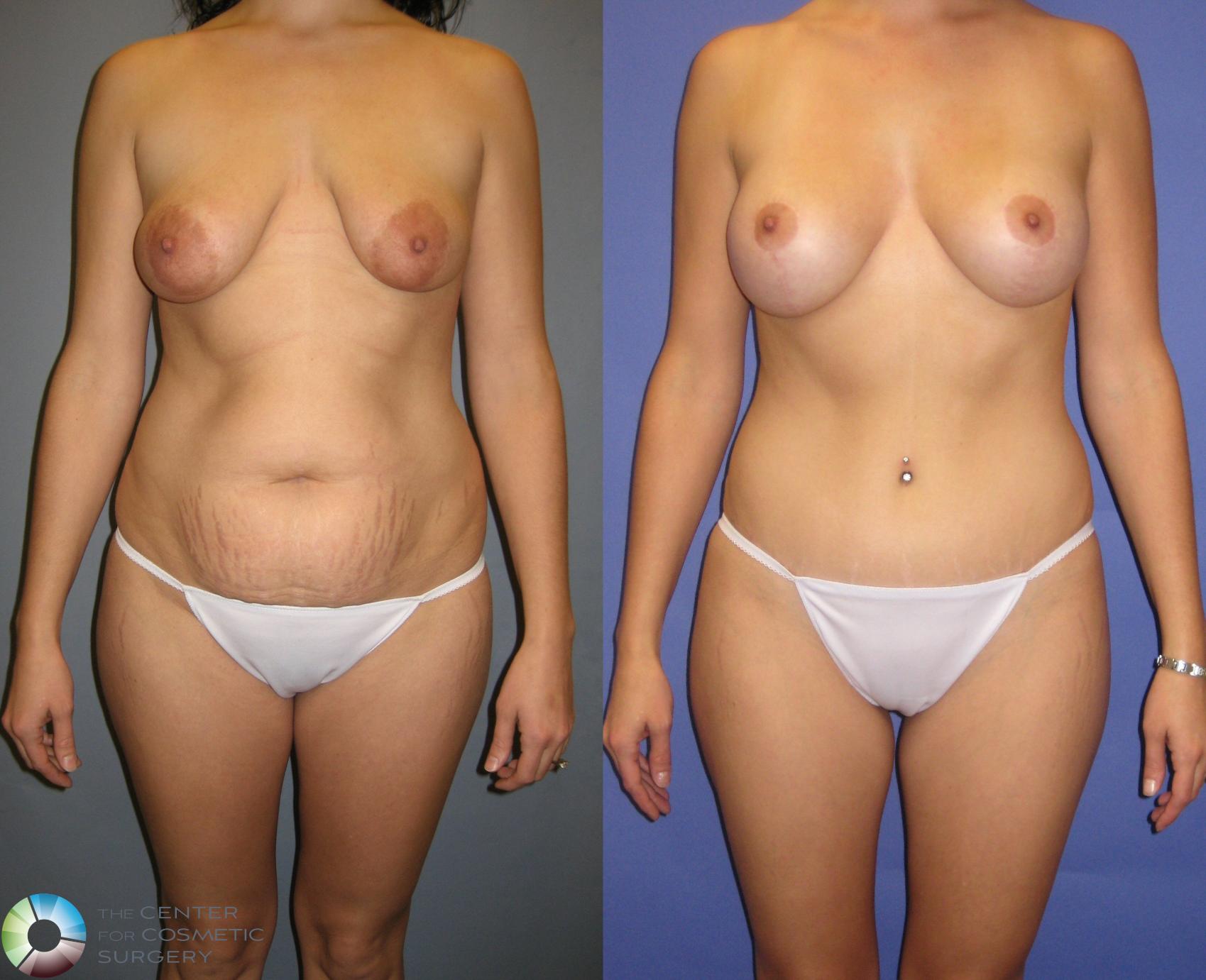 Before & After Breast Augmentation Case 328 View #1 in Denver, CO