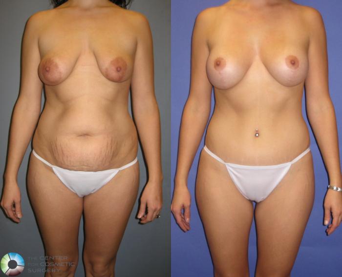 Before & After Breast Lift Case 328 View #1 View in Golden, CO