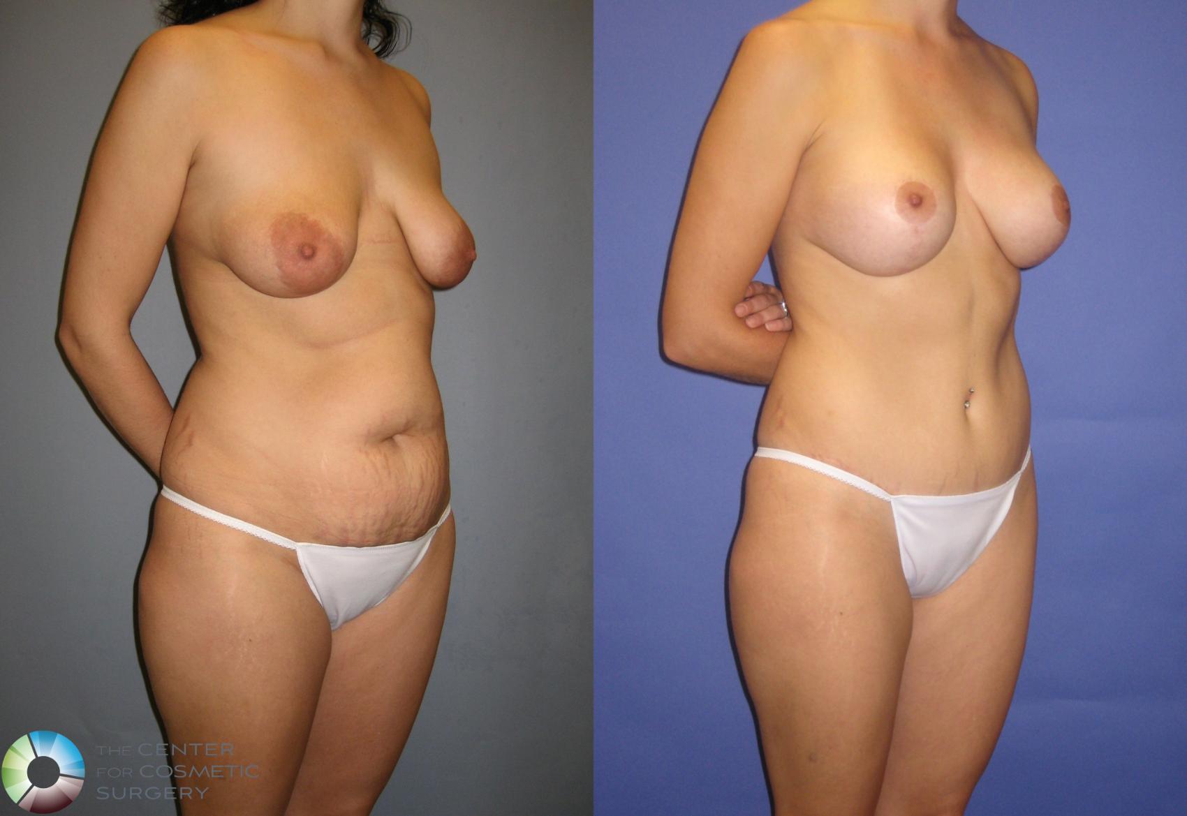 Before & After Tummy Tuck Case 328 View #2 in Denver and Colorado Springs, CO