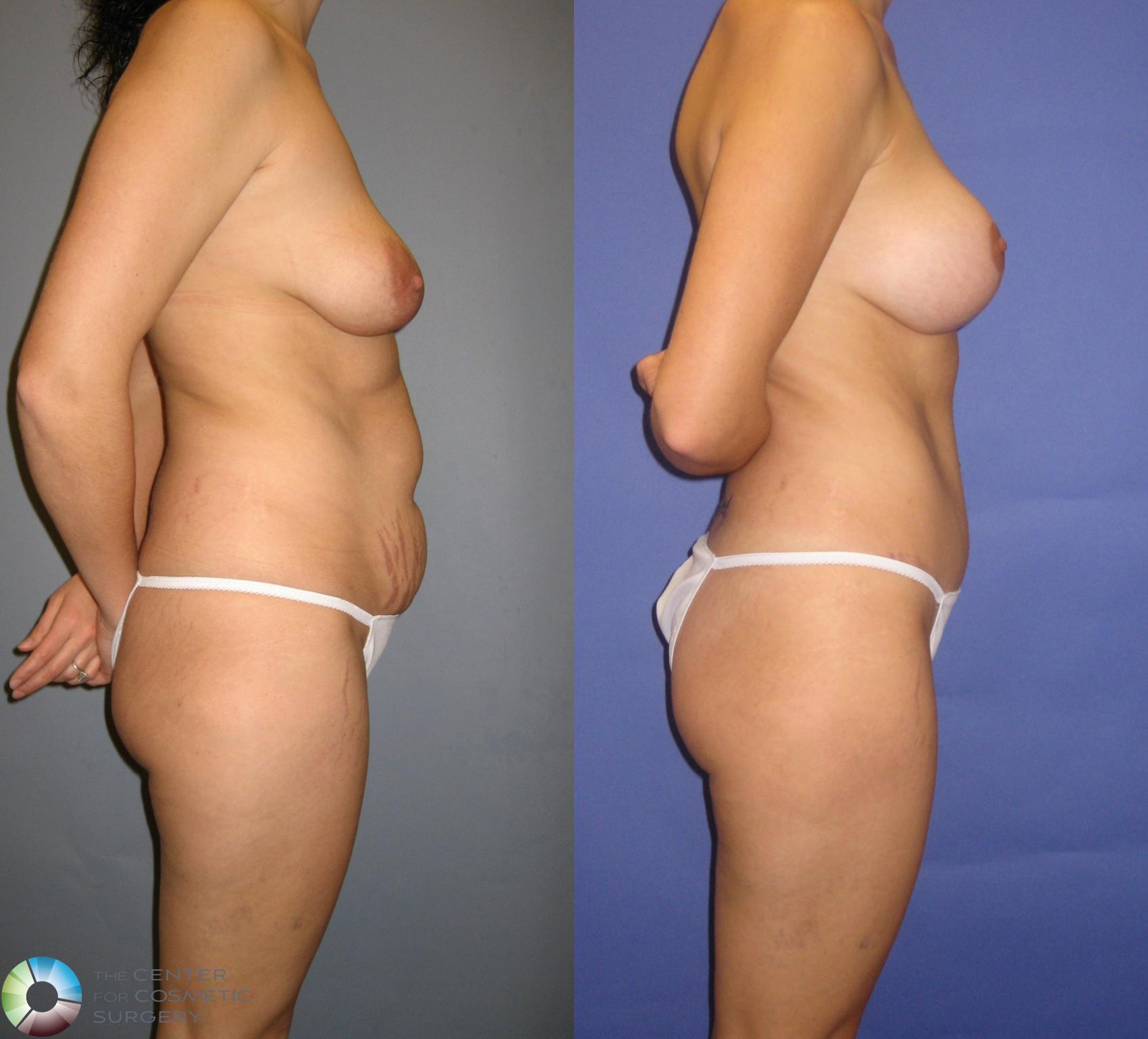 Before & After Tummy Tuck Case 328 View #3 in Denver and Colorado Springs, CO
