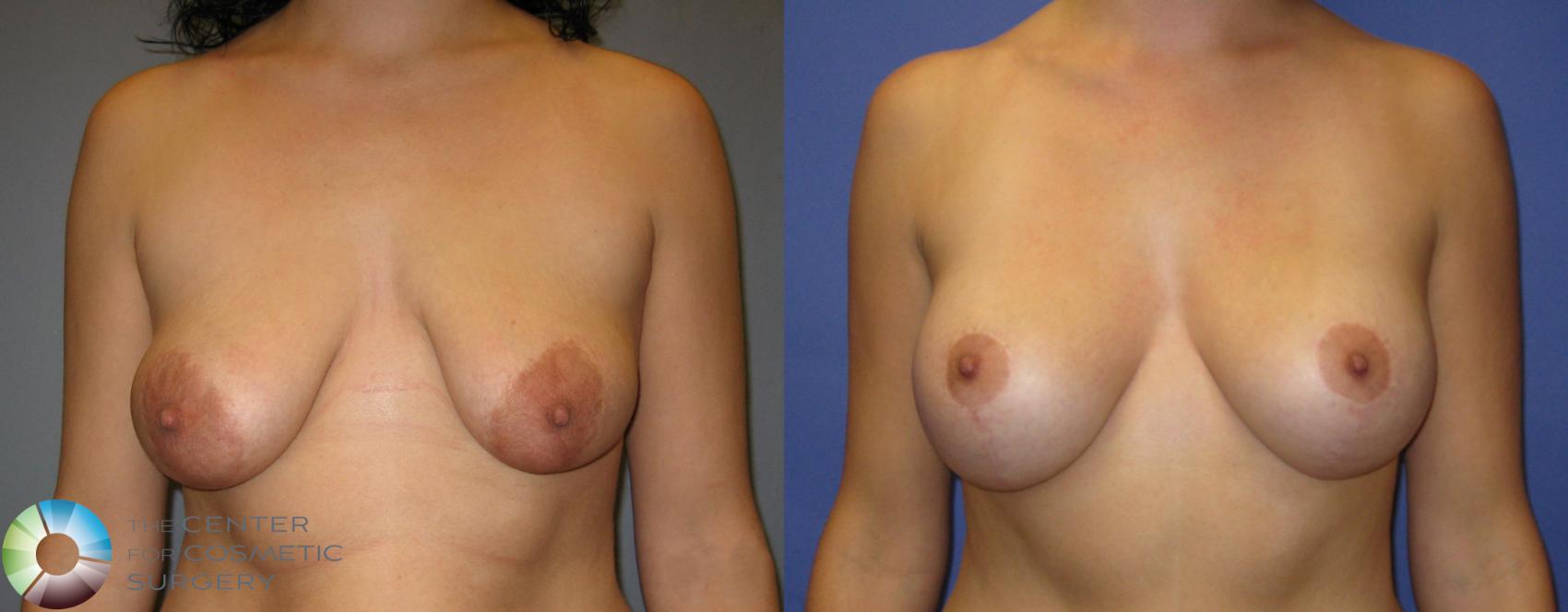 Before & After Tummy Tuck Case 328 View #4 in Denver and Colorado Springs, CO