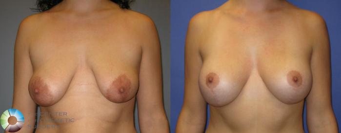 Before & After Tummy Tuck Case 328 View #4 View in Golden, CO
