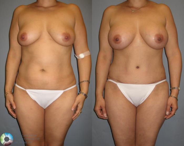 Before & After Tummy Tuck Case 329 View #1 View in Golden, CO