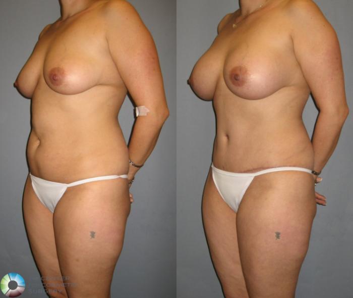 Before & After Tummy Tuck Case 329 View #2 View in Golden, CO