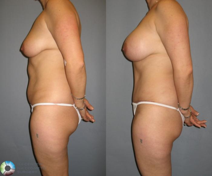 Before & After Tummy Tuck Case 329 View #3 View in Golden, CO
