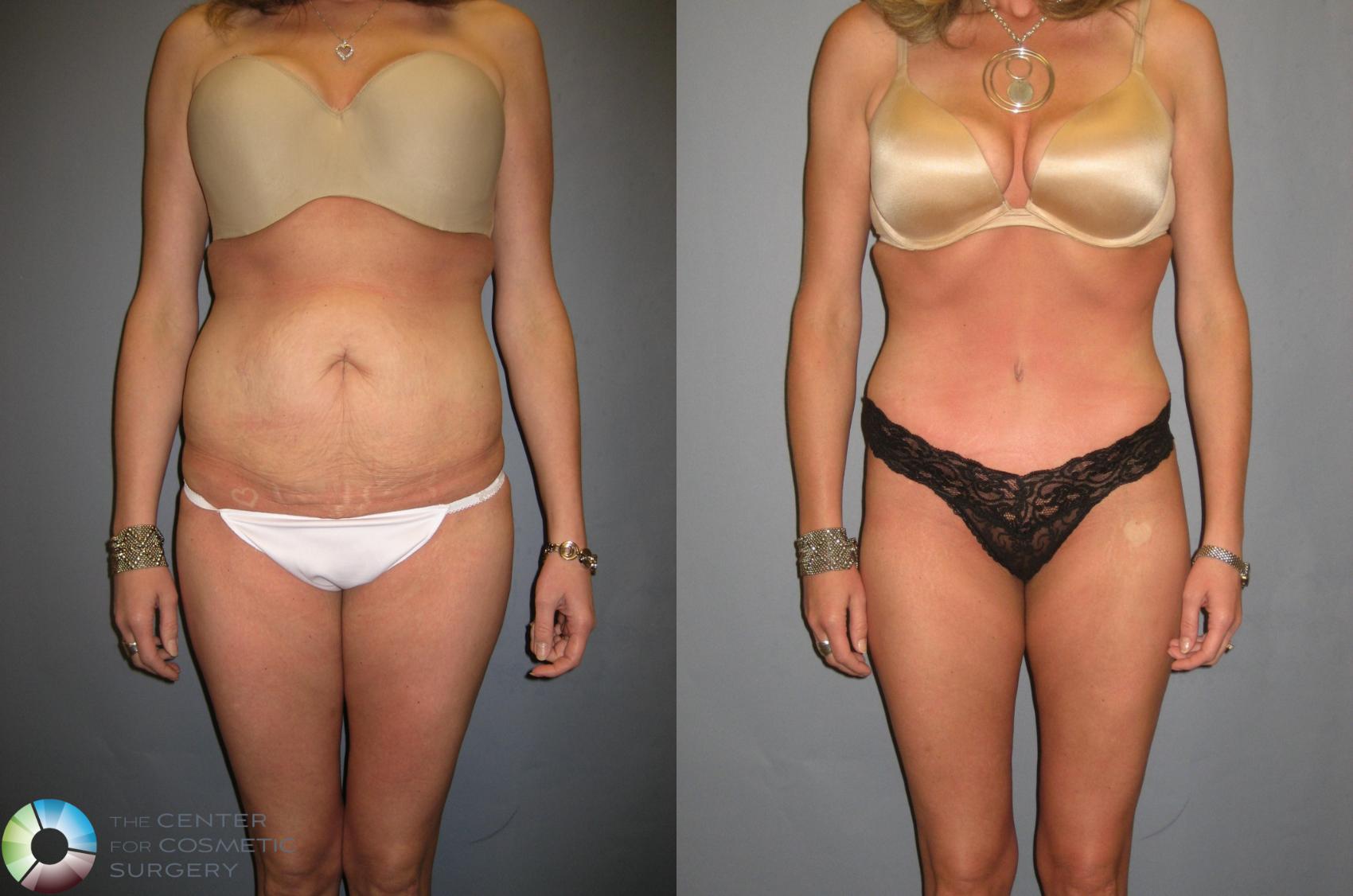 Before & After Tummy Tuck Case 333 View #1 View in Golden, CO