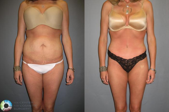 Before & After Tummy Tuck Case 333 View #1 in Denver and Colorado Springs, CO