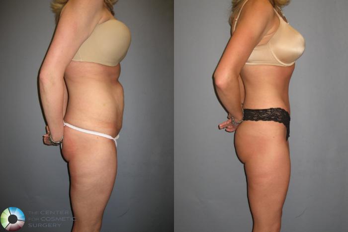 Before & After Tummy Tuck Case 333 View #2 in Denver and Colorado Springs, CO