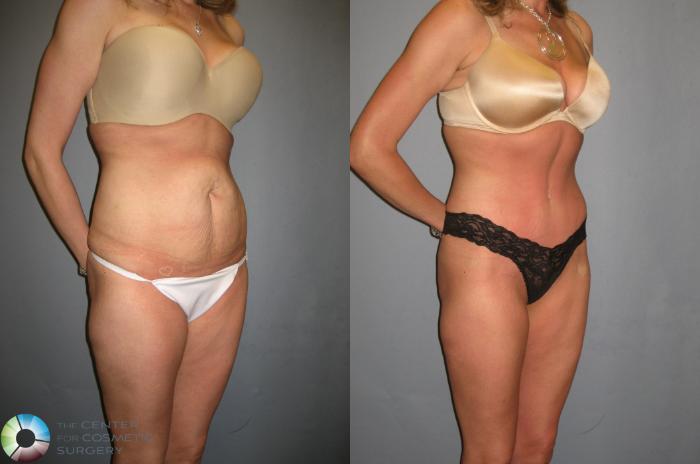 Before & After Tummy Tuck Case 333 View #3 in Denver and Colorado Springs, CO
