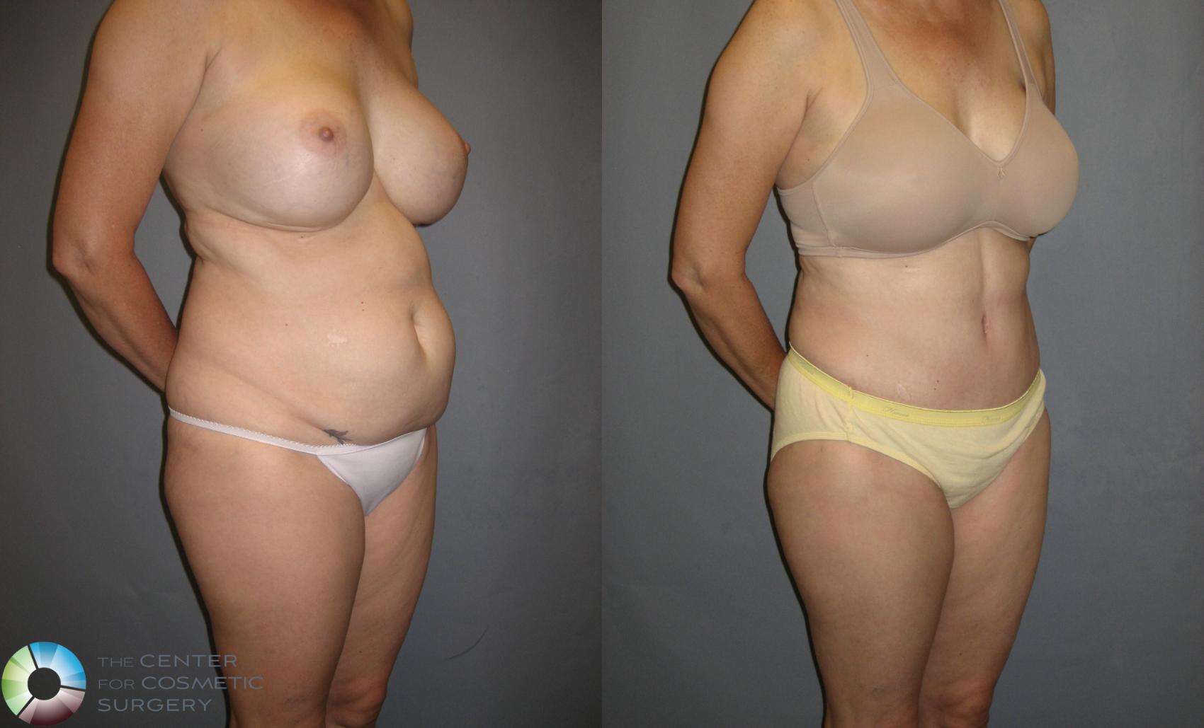 Before & After Tummy Tuck Case 336 View #1 in Denver and Colorado Springs, CO