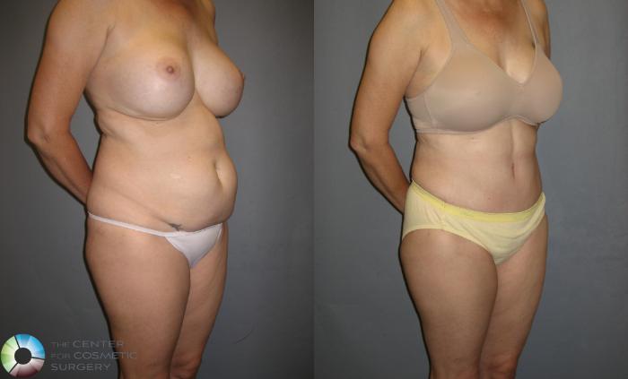 Before & After Tummy Tuck Case 336 View #1 View in Golden, CO