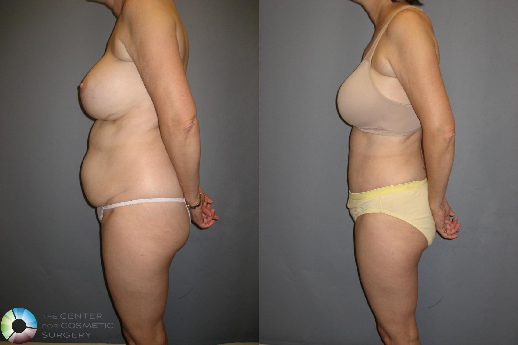 Before & After Tummy Tuck Case 336 View #2 View in Golden, CO