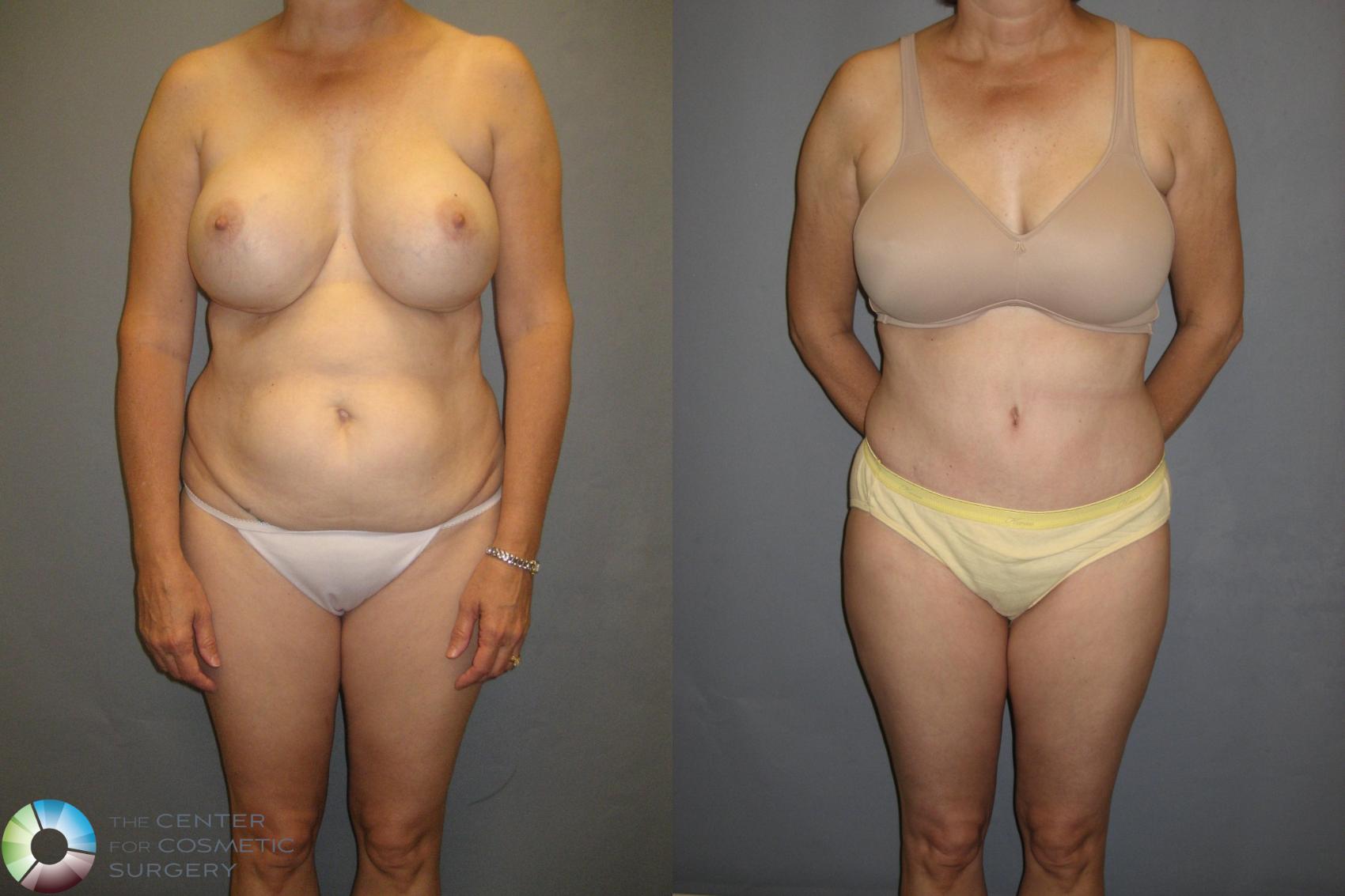 Before & After Tummy Tuck Case 336 View #3 View in Golden, CO