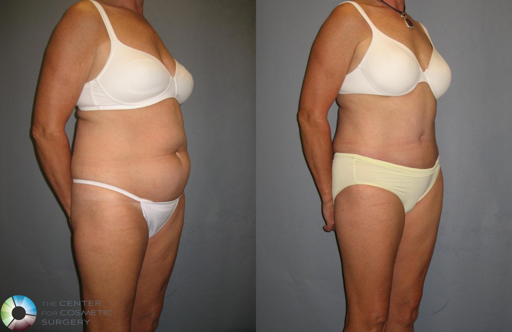 Before & After Tummy Tuck Case 337 View #1 View in Golden, CO