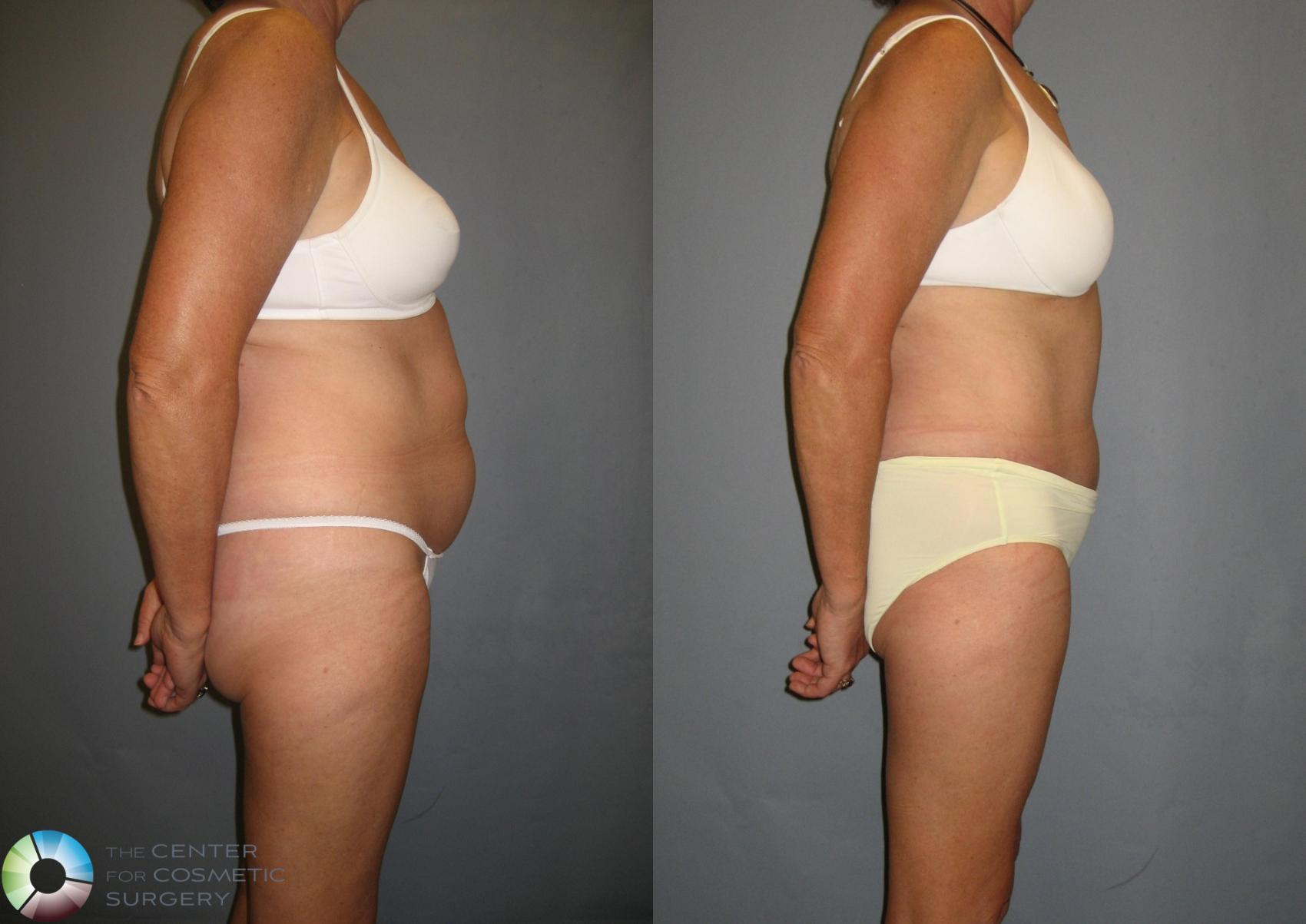 Before & After Tummy Tuck Case 337 View #2 in Denver and Colorado Springs, CO