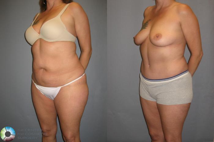Before & After Tummy Tuck Case 339 View #1 in Denver and Colorado Springs, CO