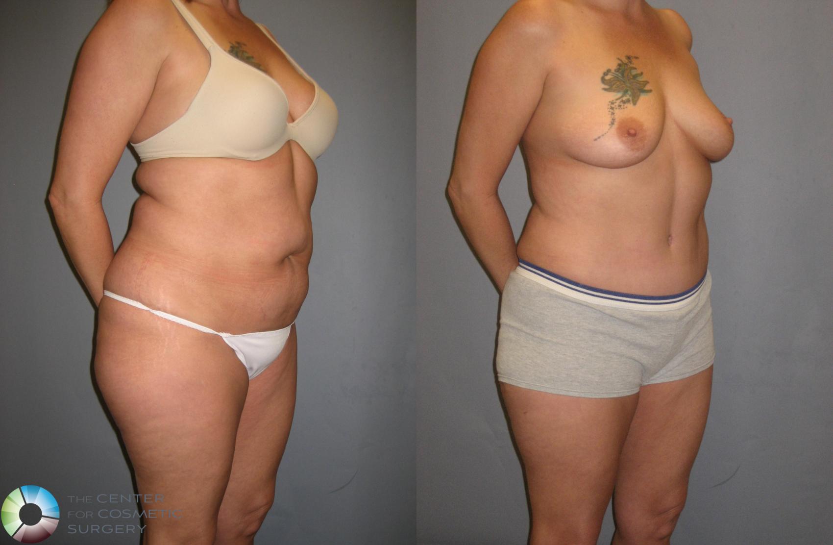 Before & After Tummy Tuck Case 339 View #2 View in Golden, CO
