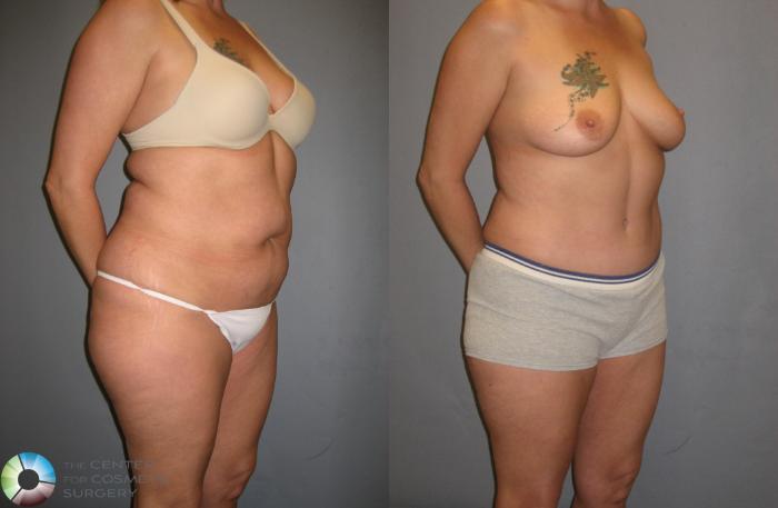 Before & After Tummy Tuck Case 339 View #2 in Denver and Colorado Springs, CO
