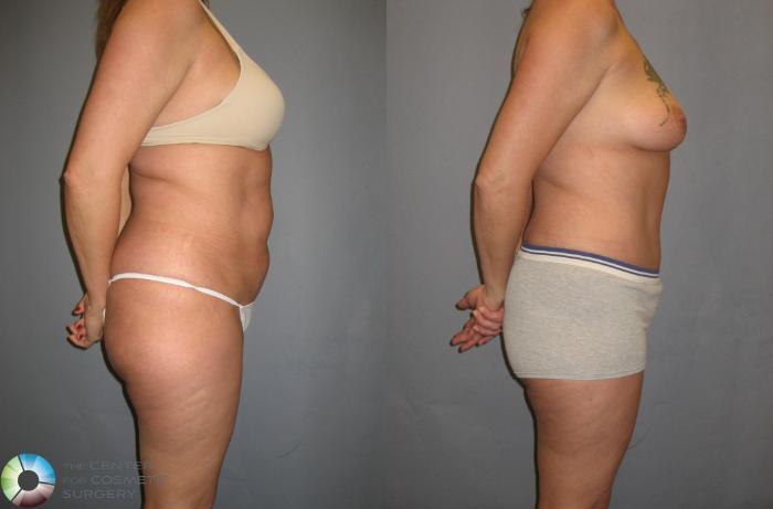 Before & After Tummy Tuck Case 339 View #3 in Denver and Colorado Springs, CO