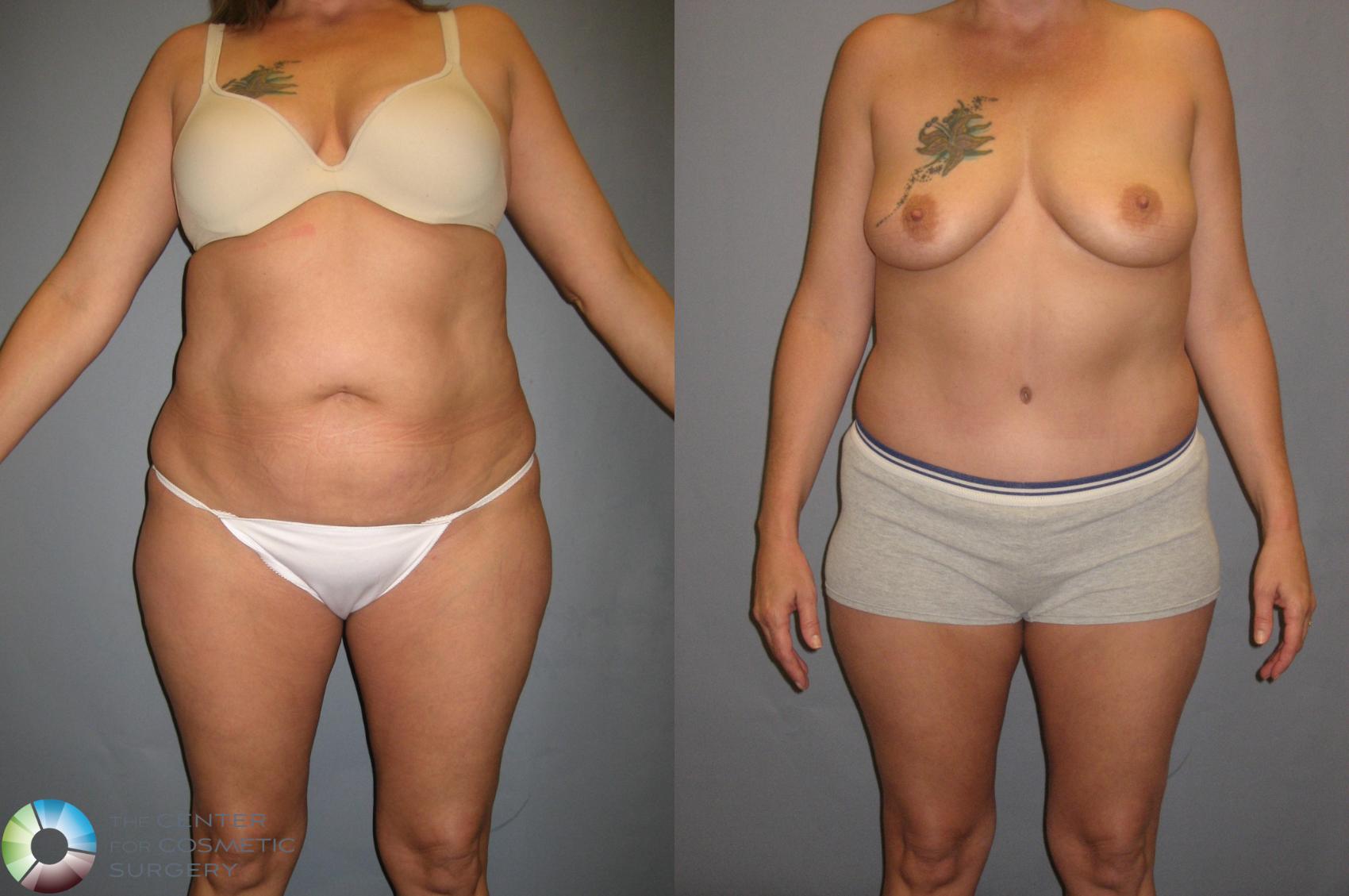 Before & After Tummy Tuck Case 339 View #4 View in Golden, CO