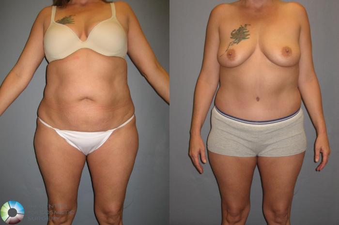 Before & After Tummy Tuck Case 339 View #4 in Denver and Colorado Springs, CO