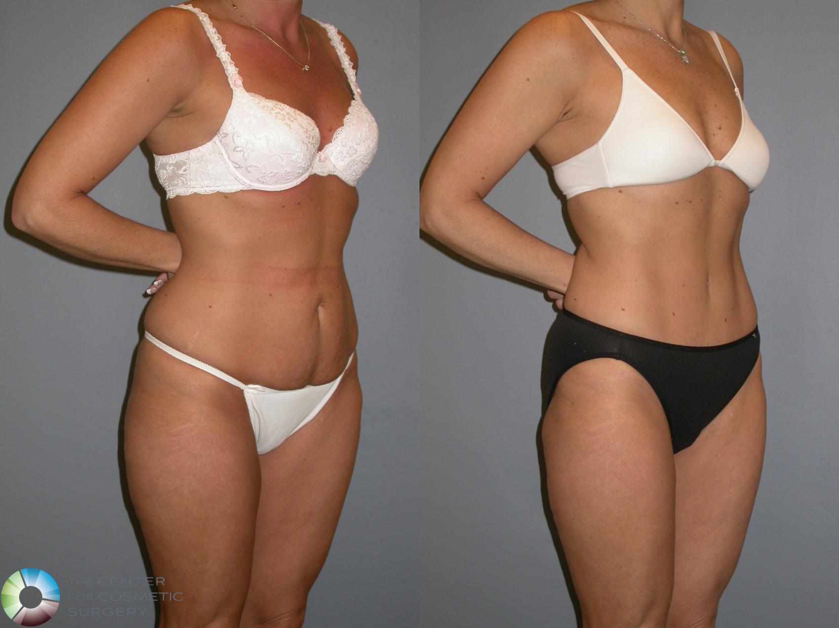 Before & After Tummy Tuck Case 343 View #1 View in Golden, CO