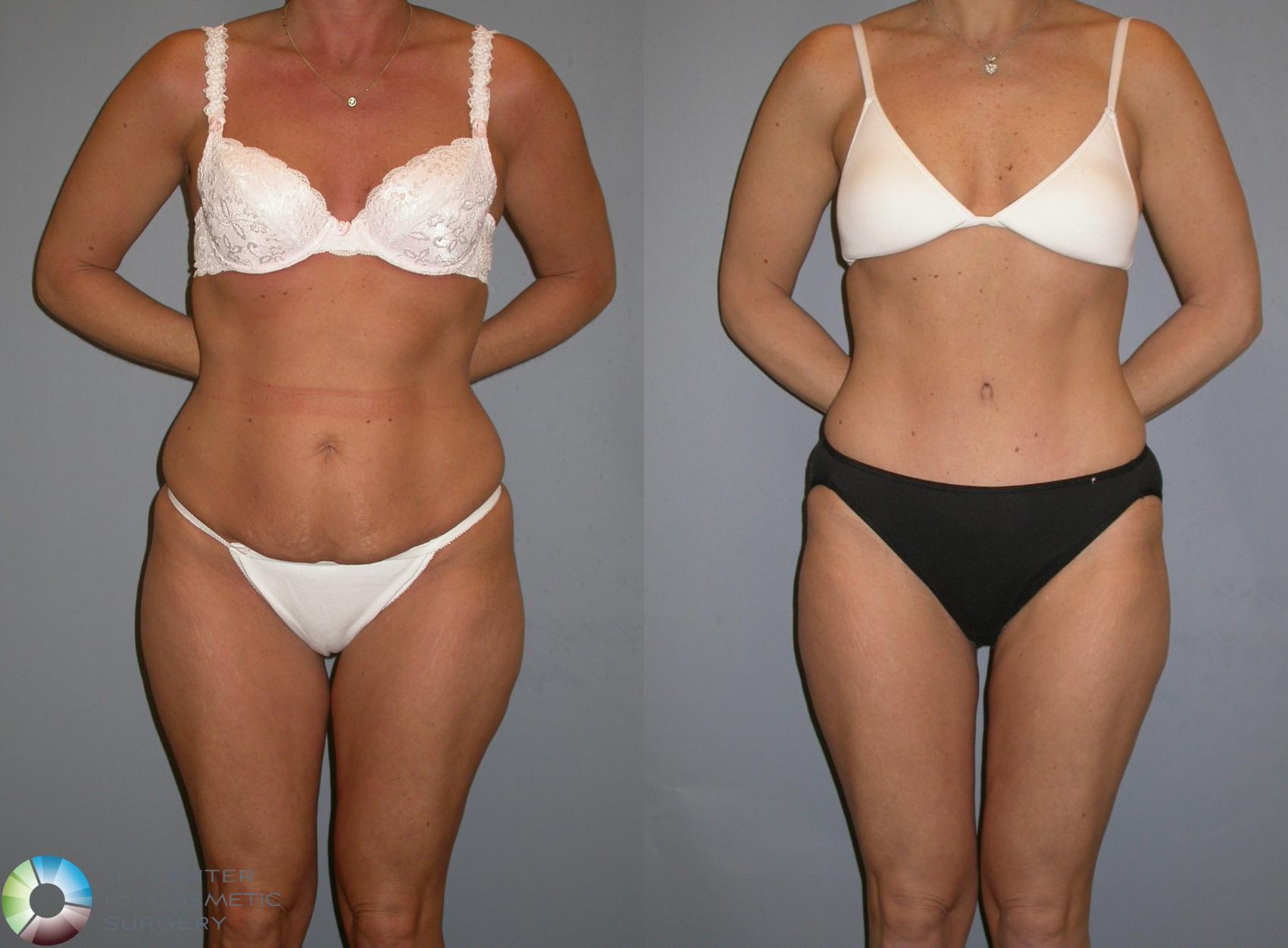 Before & After Tummy Tuck Case 343 View #2 View in Golden, CO