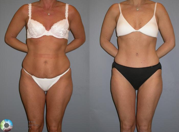 Before & After Tummy Tuck Case 343 View #2 in Denver, CO